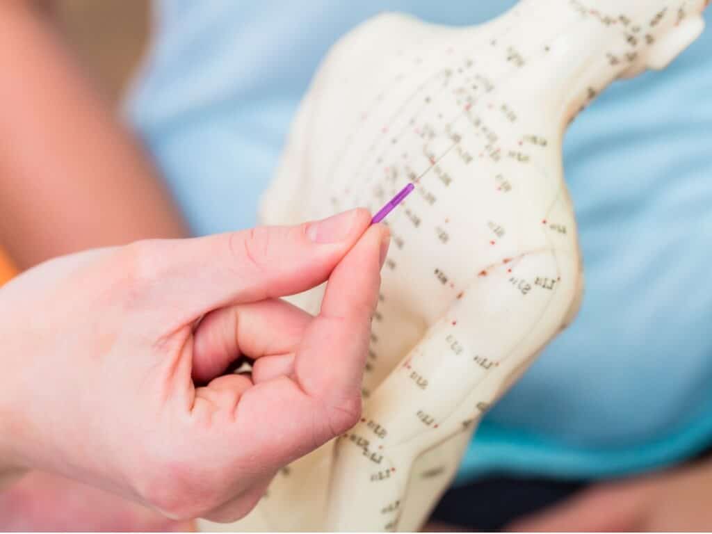 Treating Stress with Acupuncture