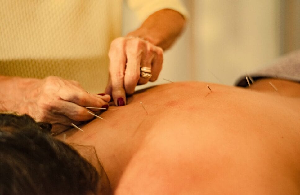 Discover Acupuncture for Stress and Anxiety 4 Acupuncturist putting acupuncture needles on someone's back. Acupuncture for stress and anxiety. Brisbane Livewell Clinic
