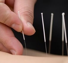 Acupuncture Helps with Eczema