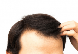 Nutrition Deficiency hair loss