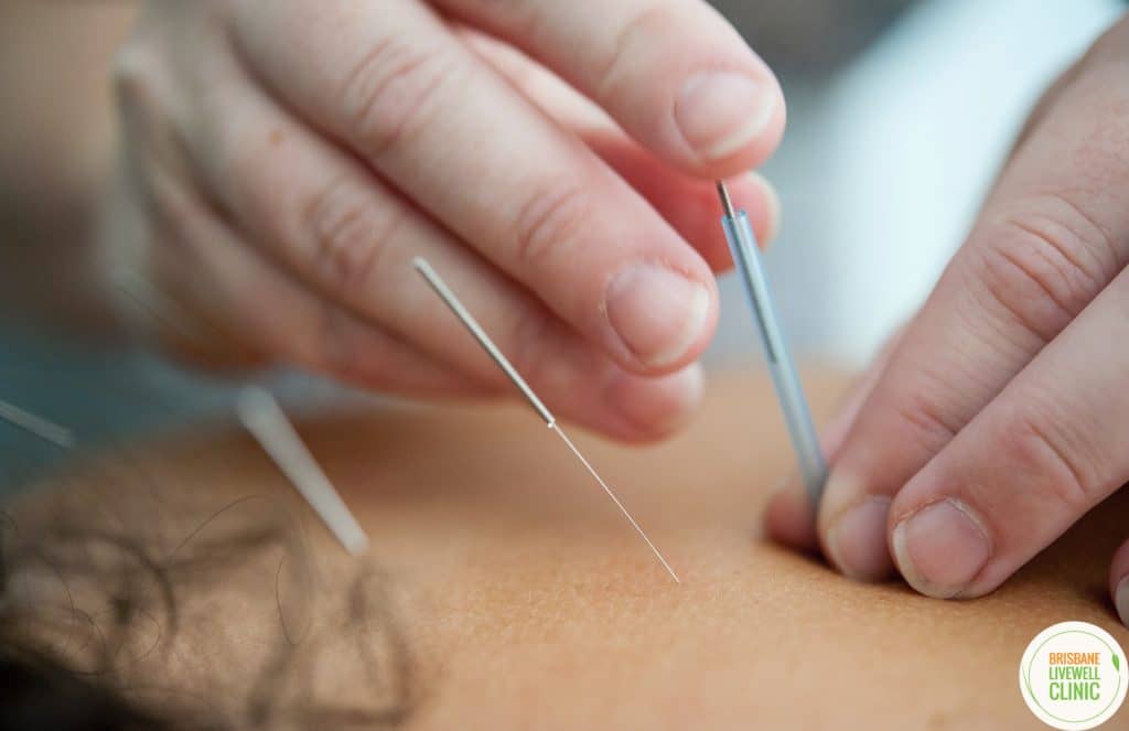 Acupuncture for Fertility and Thyroid Health