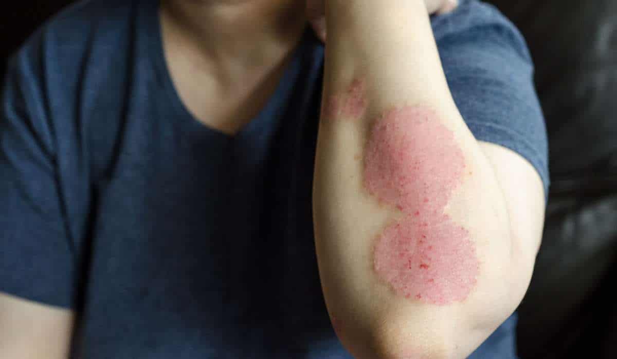 A man having Psoriasis and its Causes. Brisbane livewell Clinic.