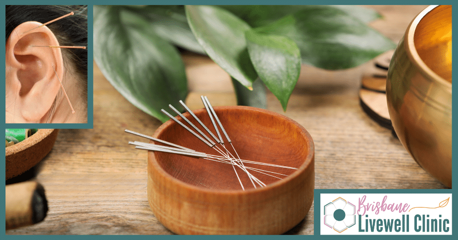 Acupuncture. Brisbane Livewell Clinic. Acupuncture needles with Ear Acupuncture inset.